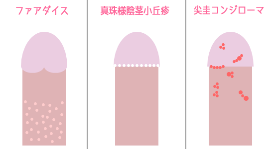 �t�H�A�_�C�X�E�^��l�A�s���u�]�A��\�R���W���[�}�Ƃ̈Ⴂ